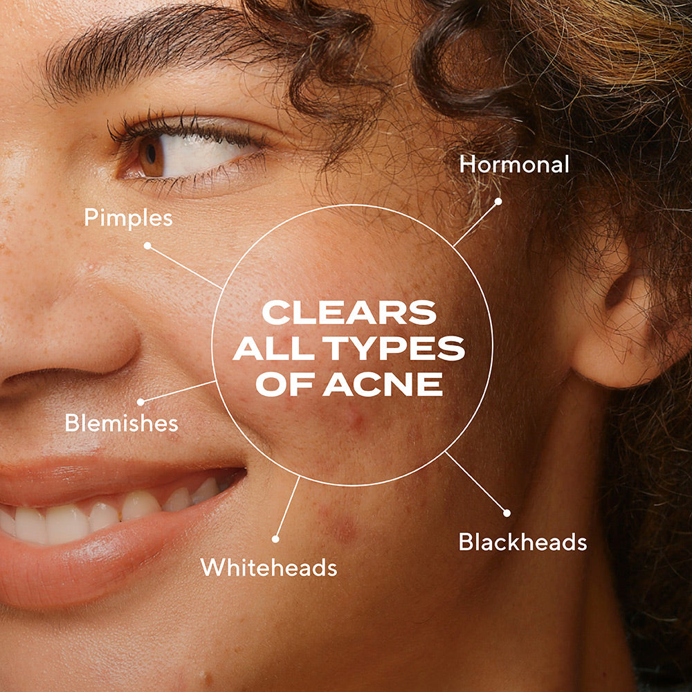 Biome-Balancing Clear & Prevent Acne Treatment Serum - Image 2